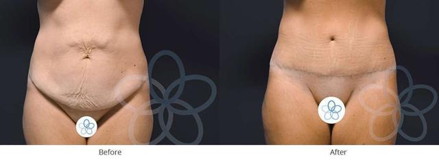 Mommy Makeover result at Newvue Plastic Surgery in Bellevue, WA