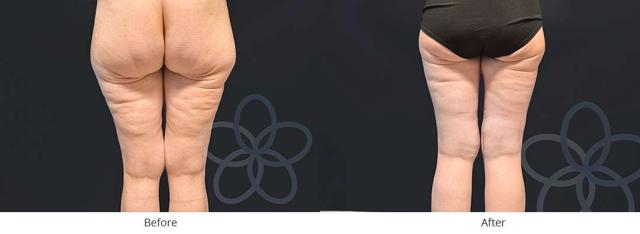 Thigh Lift result at Newvue Plastic Surgery in Bellevue, WA