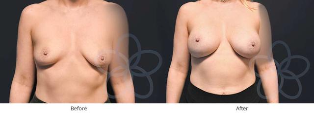 Breast Augmentation result at Newvue Plastic Surgery in Bellevue, WA