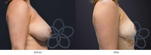 Breast Reduction result at Newvue Plastic Surgery in Bellevue, WA