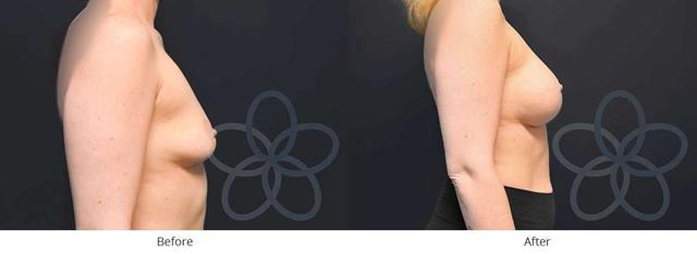 Breast Augmentation result at Newvue Plastic Surgery in Bellevue, WA