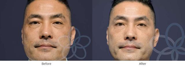 Blepharoplasty result at Newvue Plastic Surgery in Bellevue, WA