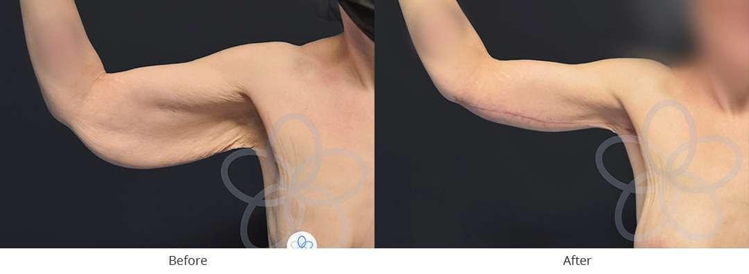 Newvue Plastic Surgery arm lift result — Bellevue, WA