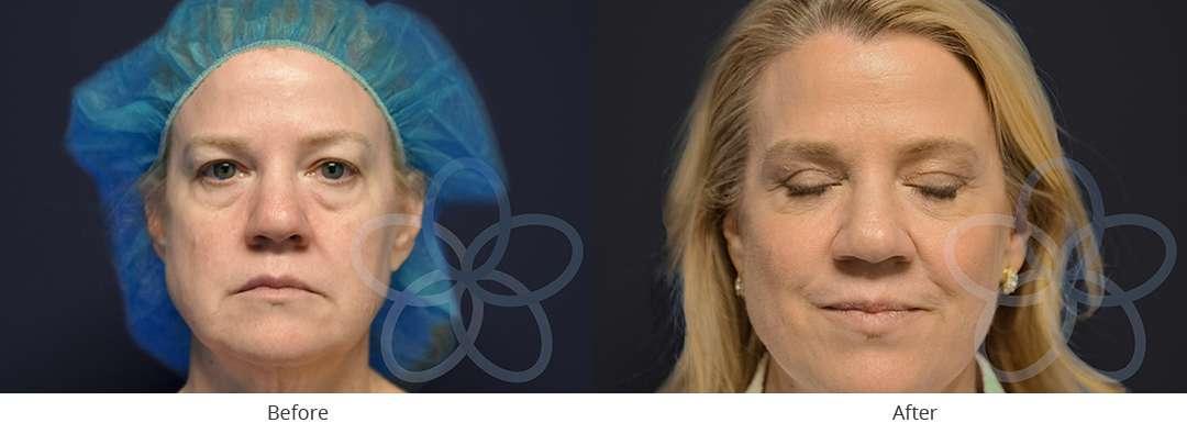 Newvue Plastic Surgery blepharoplasty result — Bellevue, WA