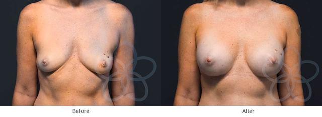 Breast Augmentation result at Newvue Plastic Surgery in Bellevue, WA