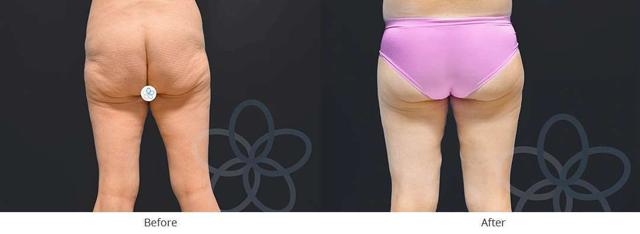 Thigh Lift result at Newvue Plastic Surgery in Bellevue, WA