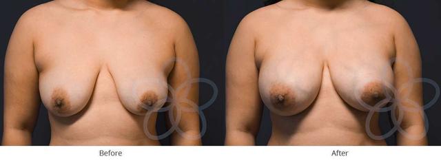 Breast Augmentation result at Newvue Plastic Surgery in Bellevue, WA