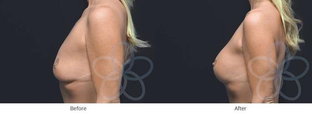 Breast Augmentation result at Newvue Plastic Surgery in Bellevue, WA