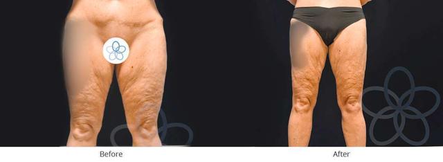 Thigh Lift result at Newvue Plastic Surgery in Bellevue, WA