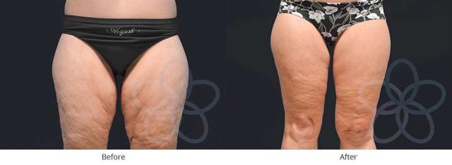 Thigh Lift result at Newvue Plastic Surgery in Bellevue, WA