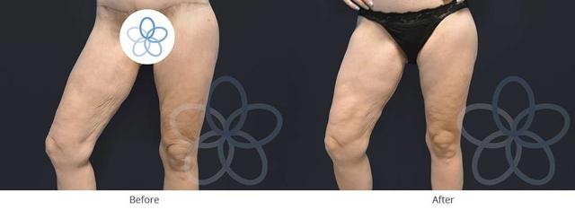 Thigh Lift result at Newvue Plastic Surgery in Bellevue, WA