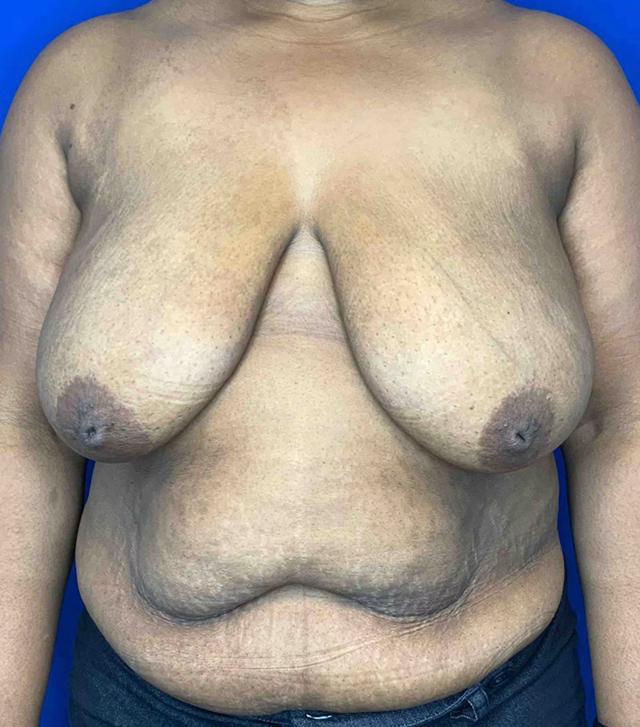 Breast Reduction before at Richmond Plastic Surgeons in Midlothian, VA