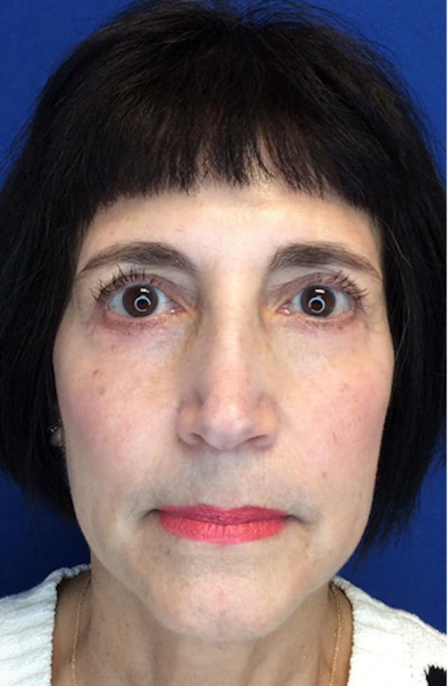 Blepharoplasty after at Richmond Plastic Surgeons in Midlothian, VA