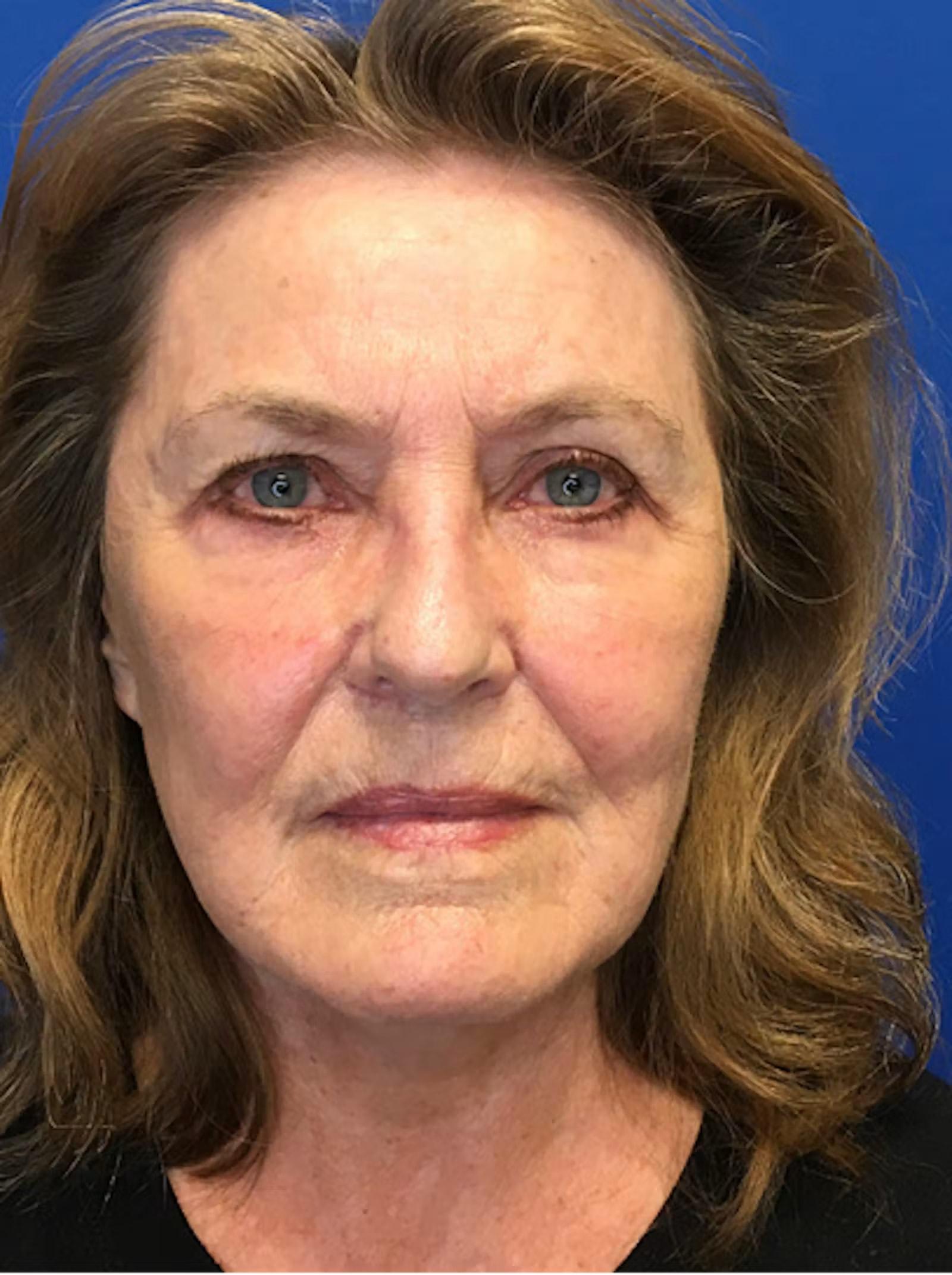 Richmond Plastic Surgeons eyelid lift after — Midlothian, VA