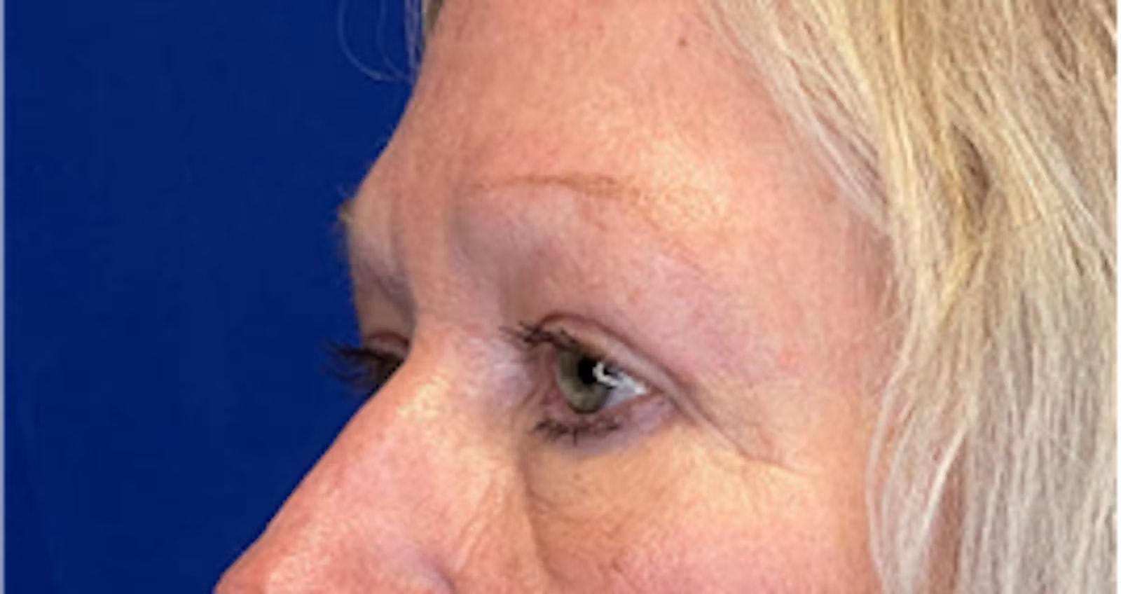 Richmond Plastic Surgeons eyelid lift after — Midlothian, VA