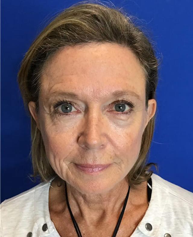 Blepharoplasty before at Richmond Plastic Surgeons in Midlothian, VA