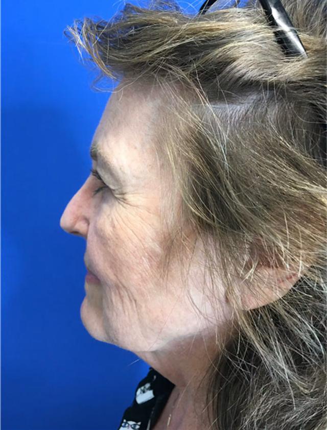 Mini Facelift before at Richmond Plastic Surgeons in Midlothian, VA