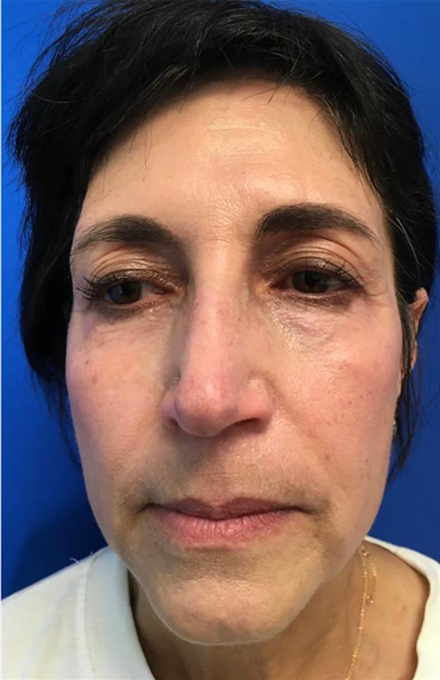 Blepharoplasty before at Richmond Plastic Surgeons in Midlothian, VA