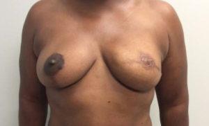 Richmond Plastic Surgeons result — Midlothian, VA