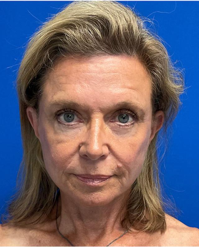 Blepharoplasty after at Richmond Plastic Surgeons in Midlothian, VA