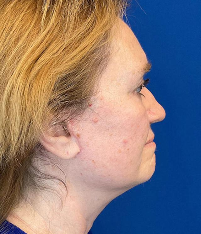 Mini Facelift after at Richmond Plastic Surgeons in Midlothian, VA