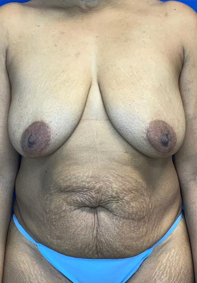 Breast Lift before at Richmond Plastic Surgeons in Midlothian, VA