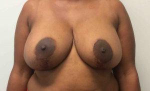 Richmond Plastic Surgeons result — Midlothian, VA