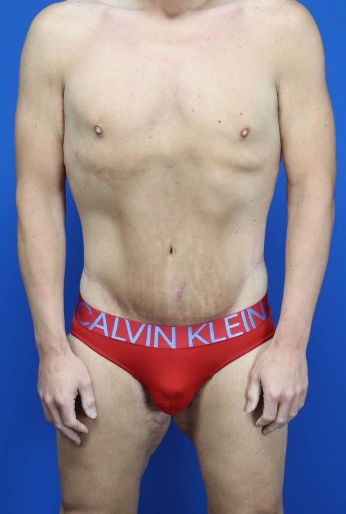 Contour Plastic Surgery and MedSpa body lift after — Downers Grove, IL