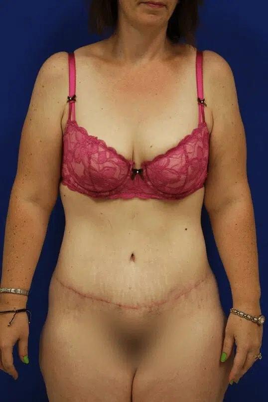 Contour Plastic Surgery and MedSpa body lift after — Downers Grove, IL