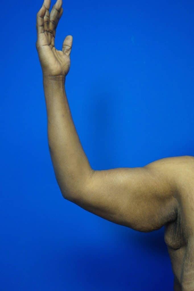 Contour Plastic Surgery and MedSpa arm lift after — Downers Grove, IL