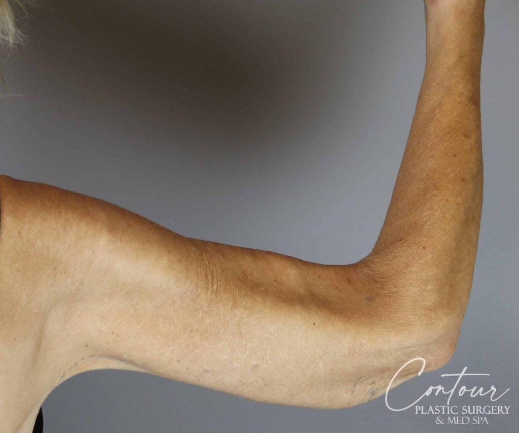 Contour Plastic Surgery and MedSpa arm lift after — Downers Grove, IL