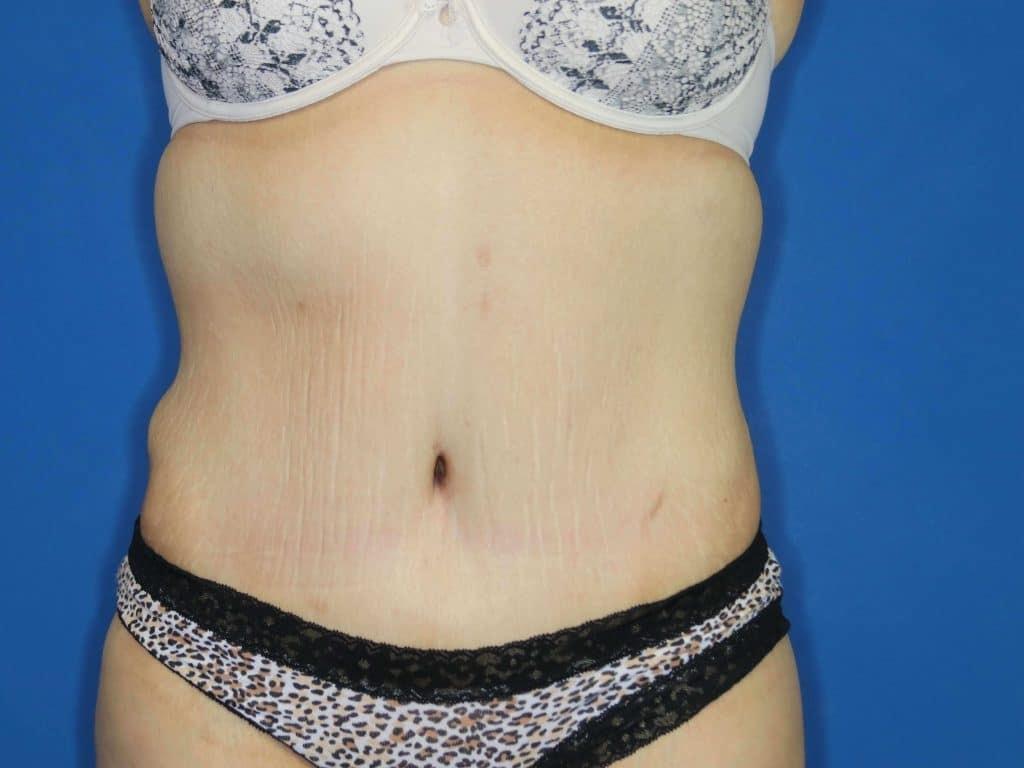 Contour Plastic Surgery and MedSpa tummy tuck after — Downers Grove, IL