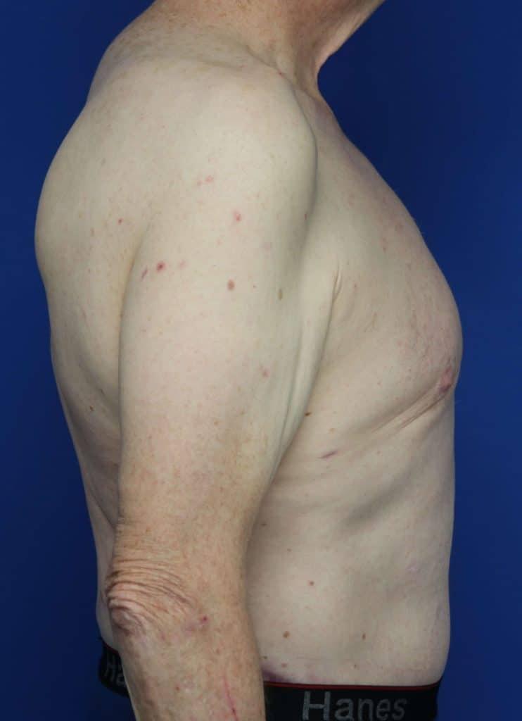 Contour Plastic Surgery and MedSpa body lift after — Downers Grove, IL