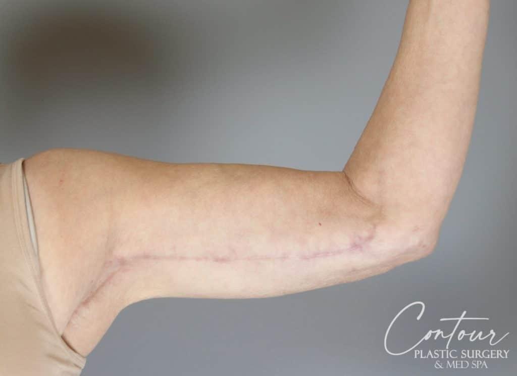 Contour Plastic Surgery and MedSpa arm lift after — Downers Grove, IL