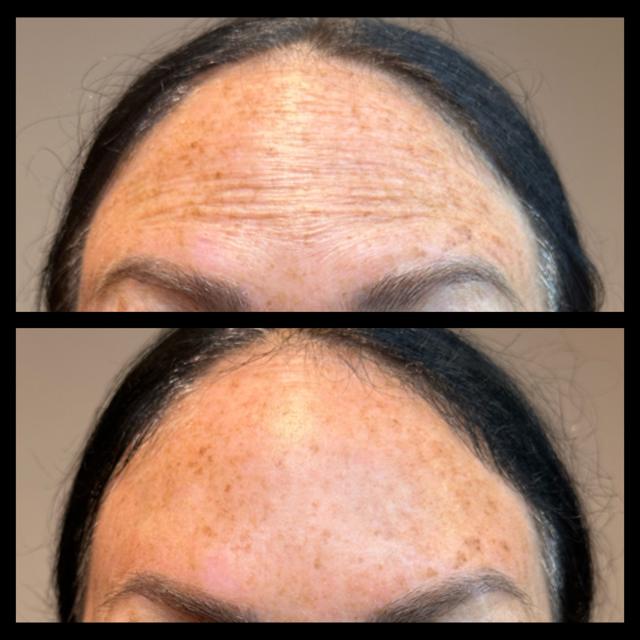 Botox result at Ethereal Beauty Buffalo in Buffalo, NY