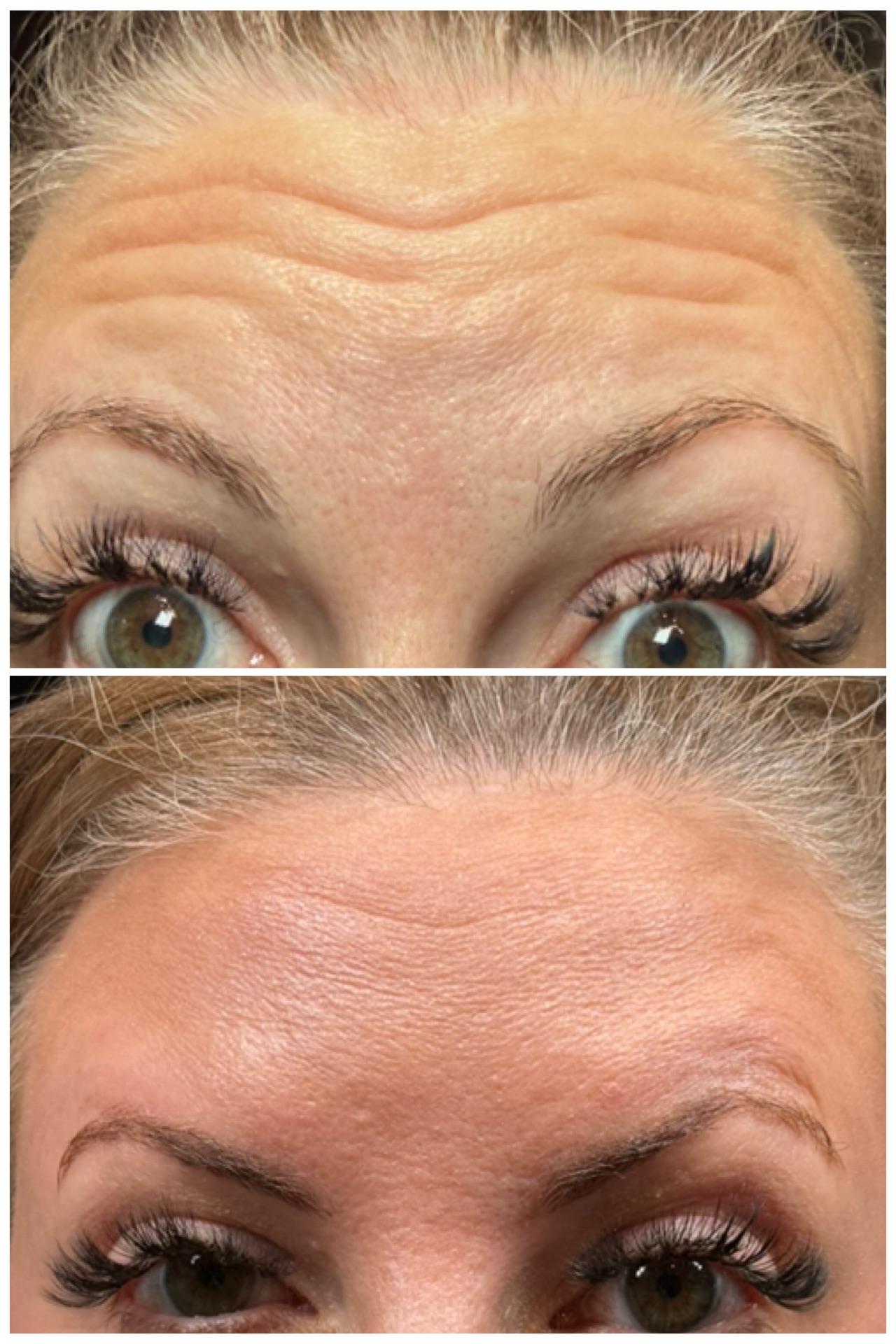 Ethereal Beauty Buffalo botox result — Buffalo, NY
