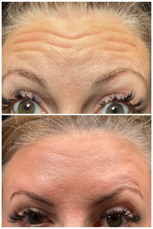 Botox result at Ethereal Beauty Buffalo in Buffalo, NY