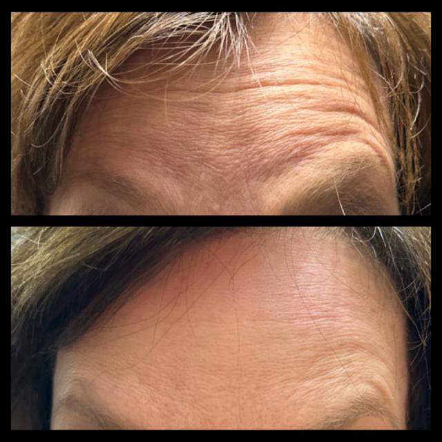 Botox result at Ethereal Beauty Buffalo in Buffalo, NY