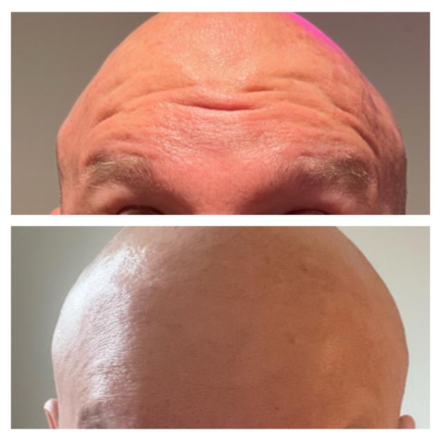 Botox result at Ethereal Beauty Buffalo in Buffalo, NY