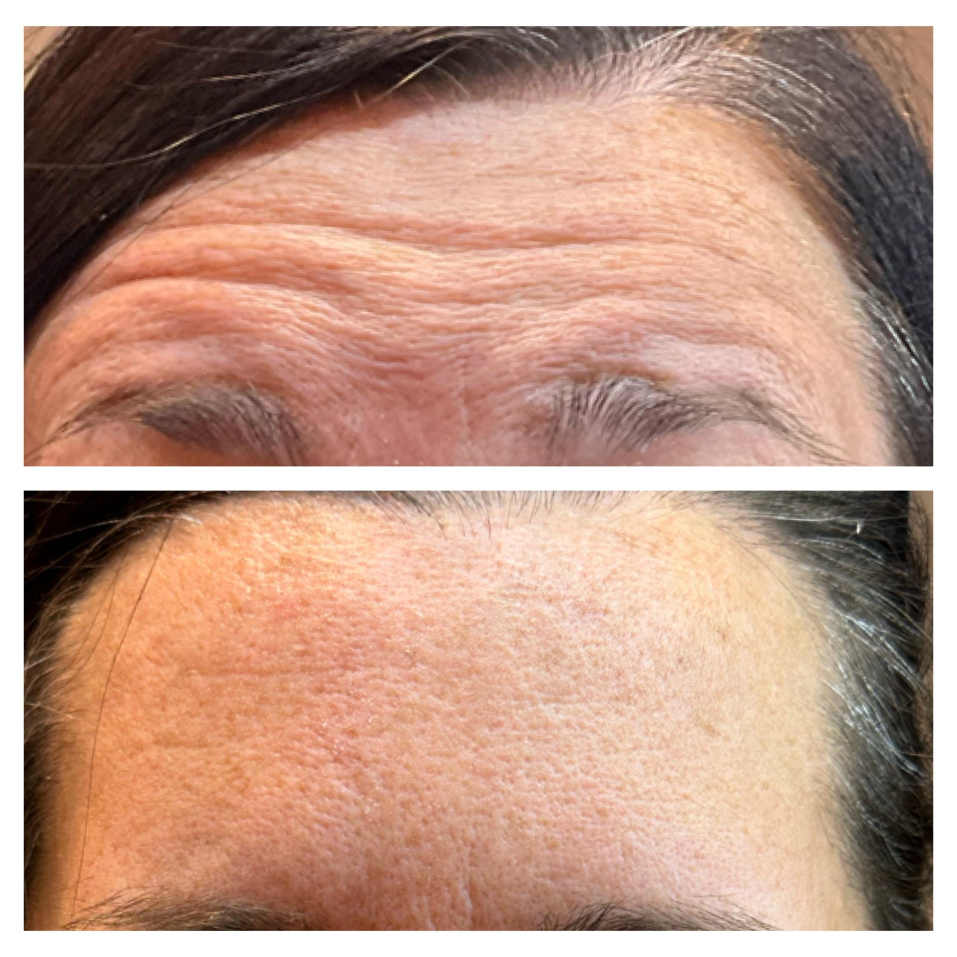 Ethereal Beauty Buffalo botox result — Buffalo, NY