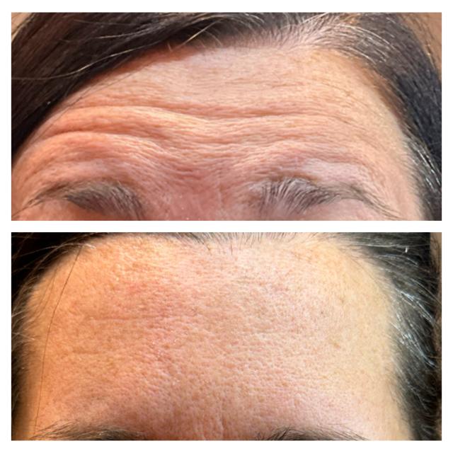 Botox result at Ethereal Beauty Buffalo in Buffalo, NY