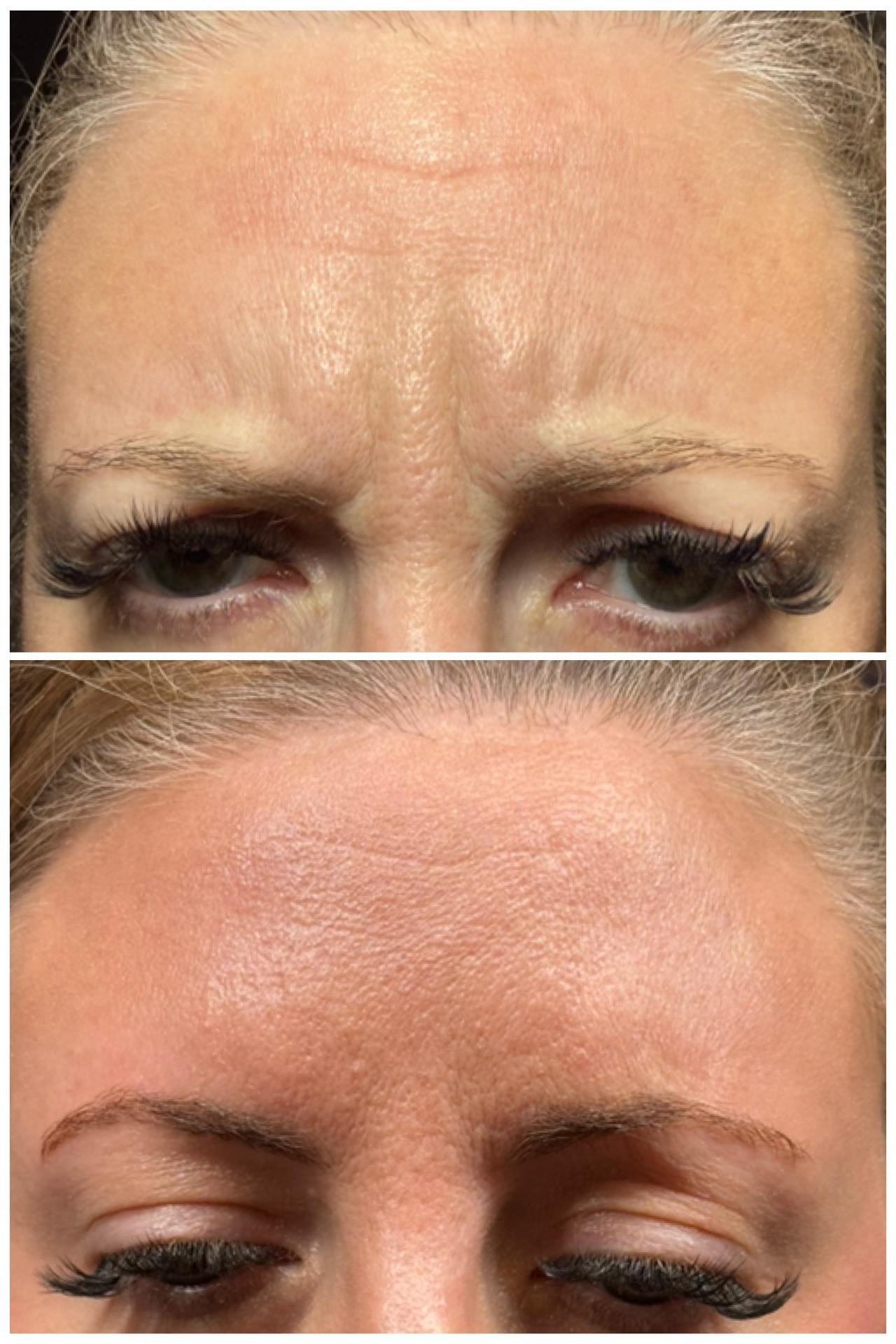 Ethereal Beauty Buffalo botox result — Buffalo, NY