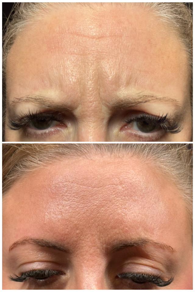 Botox result at Ethereal Beauty Buffalo in Buffalo, NY