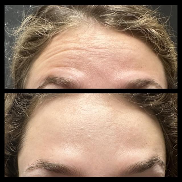 Botox result at Ethereal Beauty Buffalo in Buffalo, NY