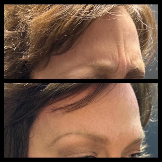 Botox result at Ethereal Beauty Buffalo in Buffalo, NY