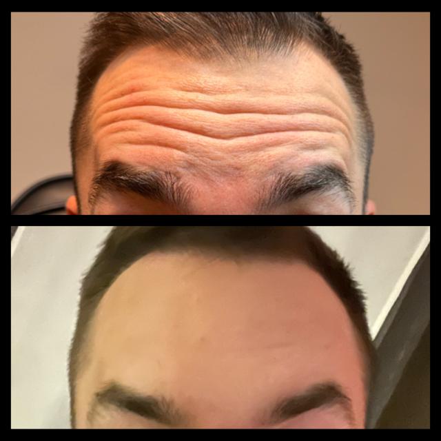 Botox result at Ethereal Beauty Buffalo in Buffalo, NY