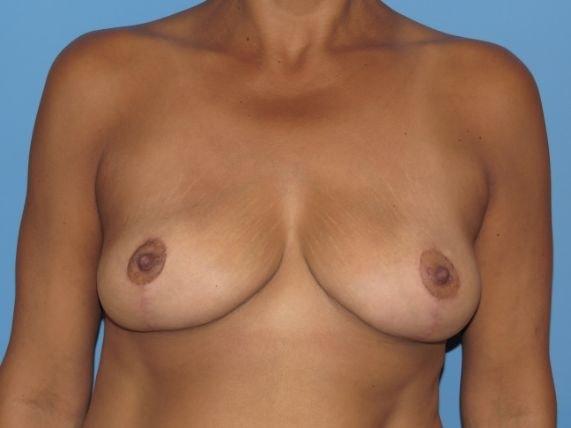 Breast Reduction after at Stephen Bresnick, MD in Los Angeles, CA