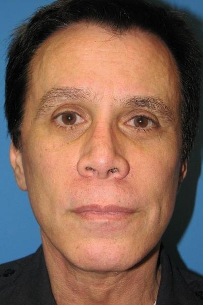 Facelift after at Stephen Bresnick, MD in Los Angeles, CA