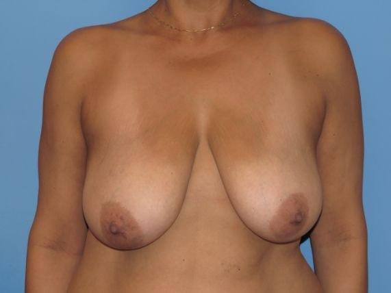 Breast Reduction before at Stephen Bresnick, MD in Los Angeles, CA