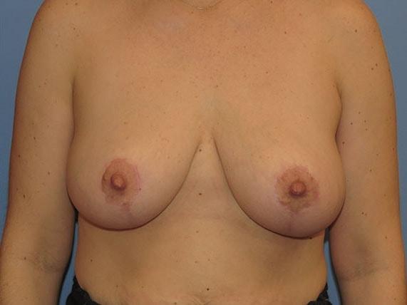 Breast Reduction after at Stephen Bresnick, MD in Los Angeles, CA